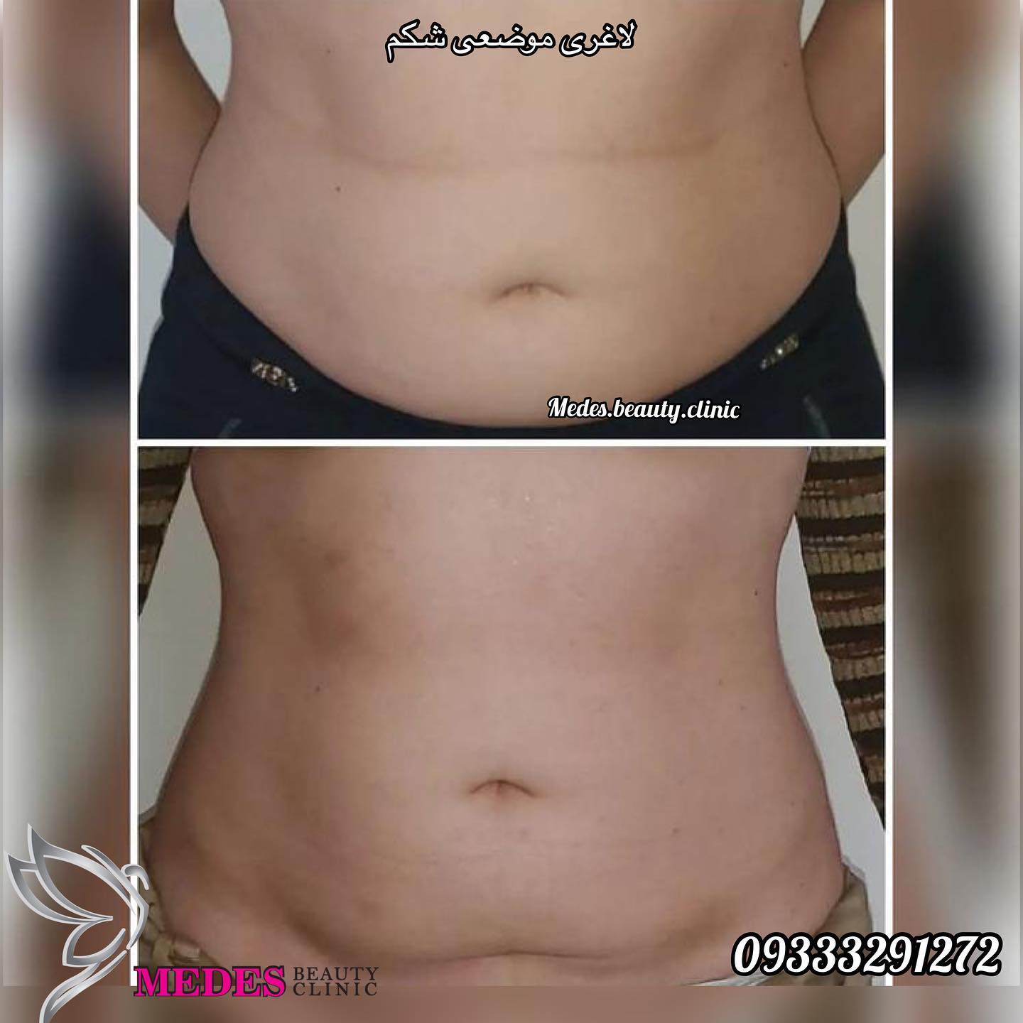 گالری لاغری با دستگاه